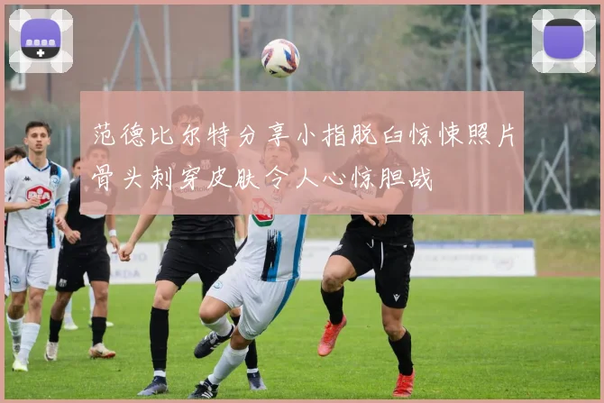 范德比尔特分享小指脱臼惊悚照片骨头刺穿皮肤令人心惊胆战